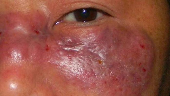 ¿Qué es el hongo negro? La infección letal que aumenta entre pacientes con Covid-19 en la India. Foto: OMS