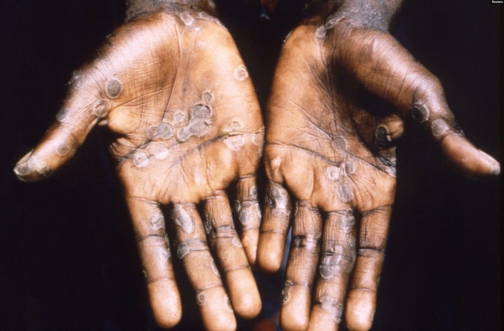 Las palmas de las manos de un paciente con viruela del mono.