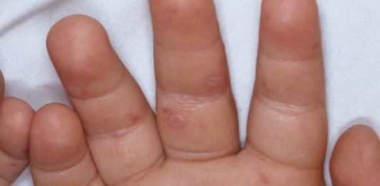 La enfermedad de manos, pies y boca es una afección leve que puede durar alrededor de 7 días desde su aparición. Imagen de referencia. Foto: Cortesía.