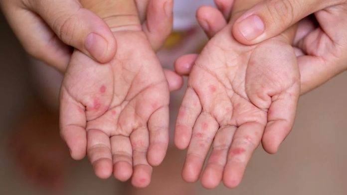 Virus Coxsackie, comúnmente conocido como "virus de manos, pies y boca". Imagen de referencia. Foto: Cortesía.