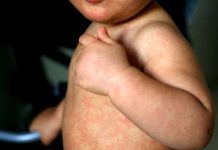 Salud confirma 11 casos importados de sarampión