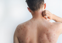 Confirman 11 casos de sarampión en El Salvador, provenientes de Guatemala y México; pacientes están bajo control y en condición estable, asegura MINSAL