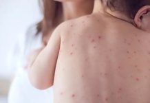 MINSAL lanza campaña de vacunación contra el sarampión dirigida a niños de 6 a 11 meses tras reporte de casos importados